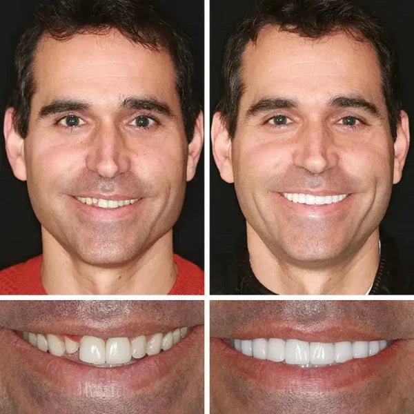 🦷 Medical Full Denture with Strong Suctiond Custom-Fit Full Functional Dentures