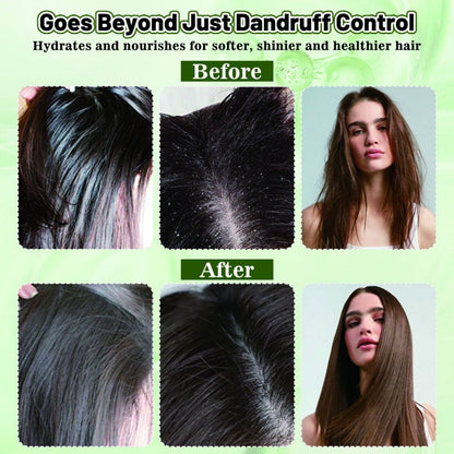 Anti-Dandruff Itch Relief Scalp Mist
